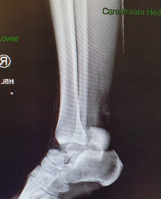 X-Ray of my right ankle, showing that my Talus (ankle bone) has broken. The bone is now lodged near my heel. This X-Ray is prior to surgery